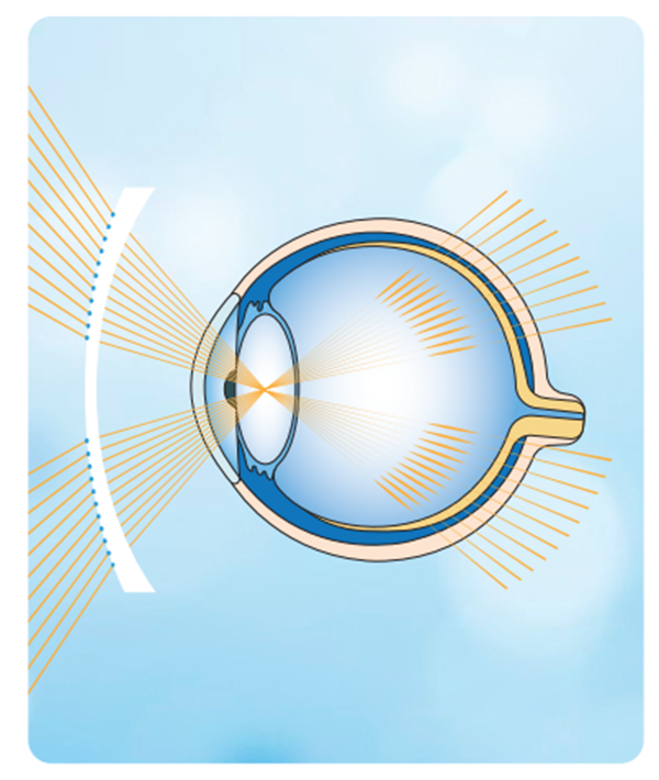 Solusi kontrol myopia kanggo bocah-bocah3