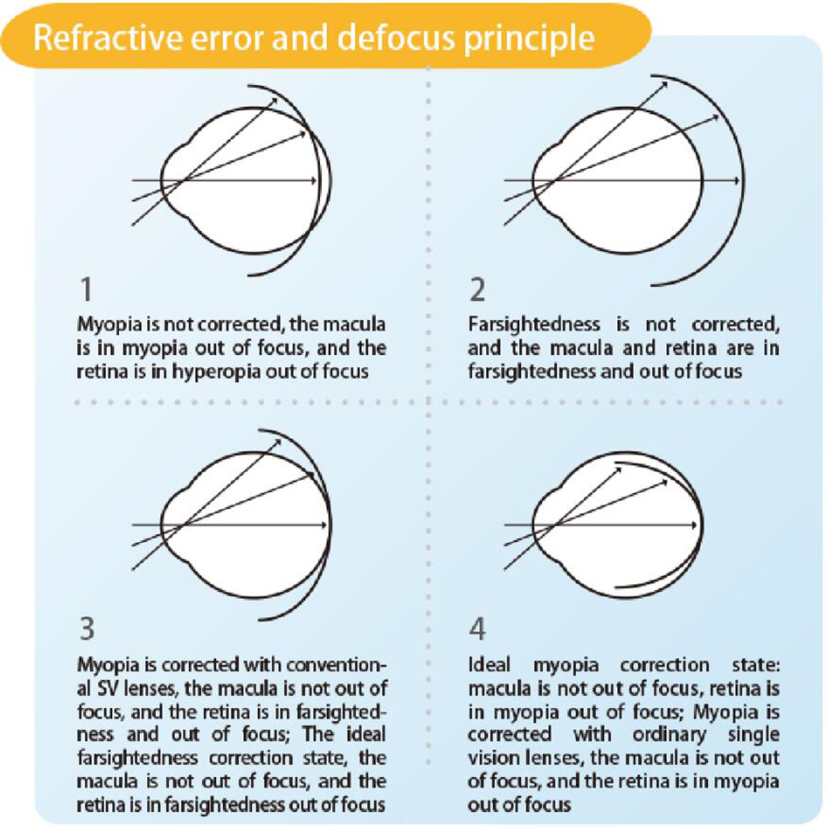 myopia4